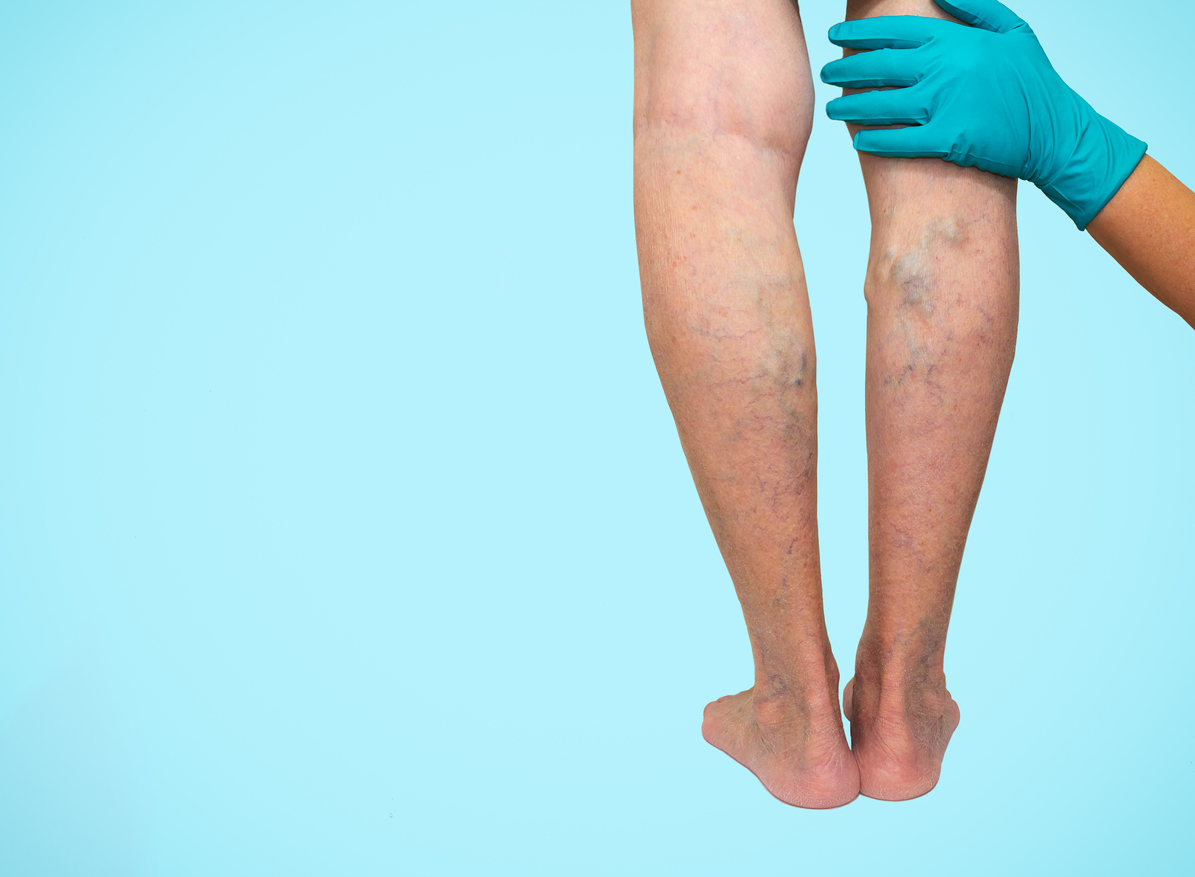 Vein Removal Los Angeles  Best Treatment for Varicose Veins