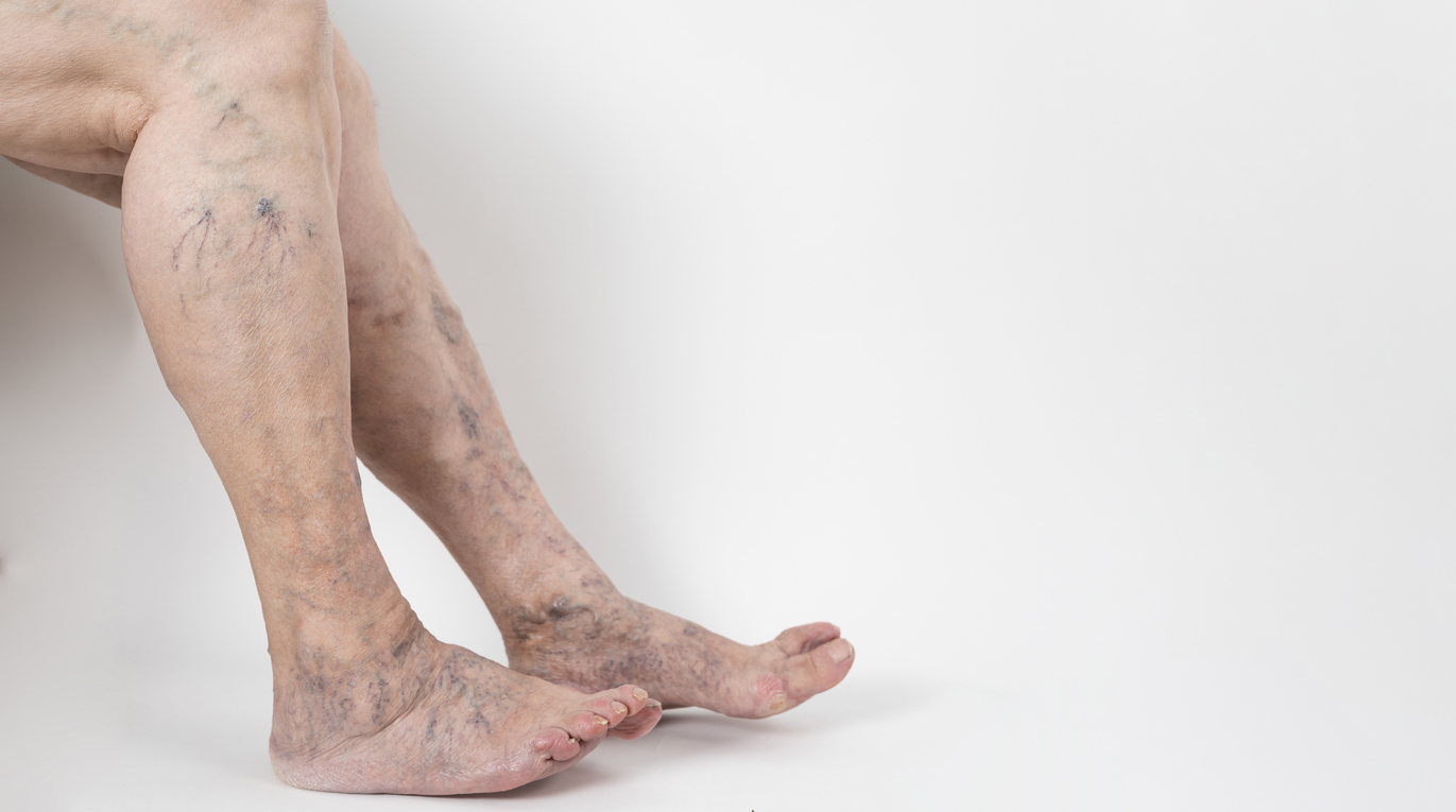 The image shows legs with severe spider vein to explain why varicose veins develop.