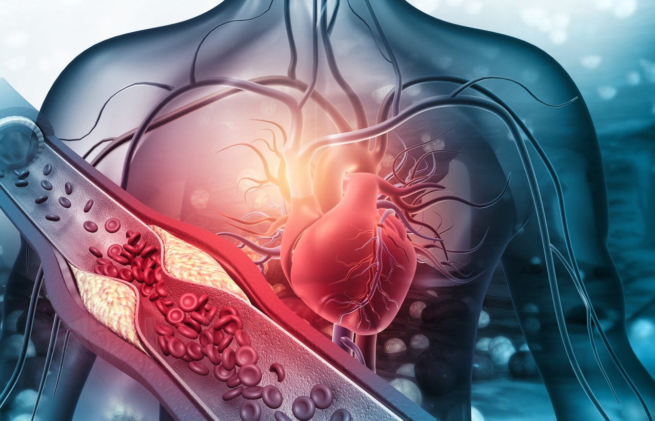 The image is a 3d illustration that highlights narrowed arteries to the reasons why arterial disease may develop.