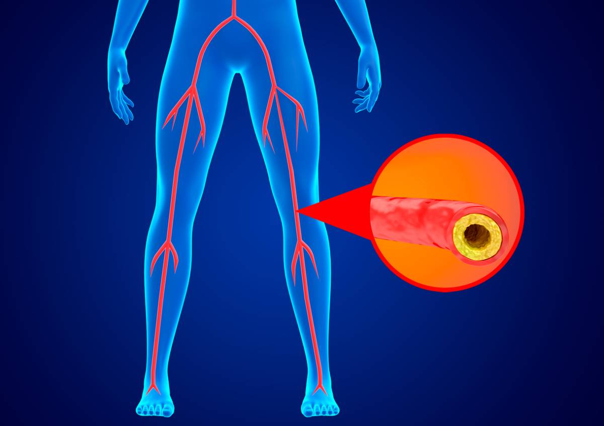 concept for why does critical limb ischemia develop